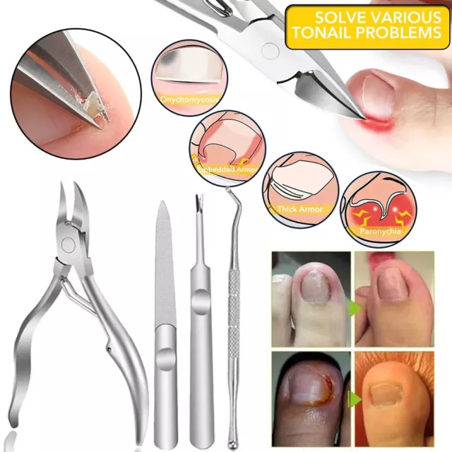 Unghie Del Piede Taglio Set Paronychia Tronchesino Incarnite Pinza Cuticole