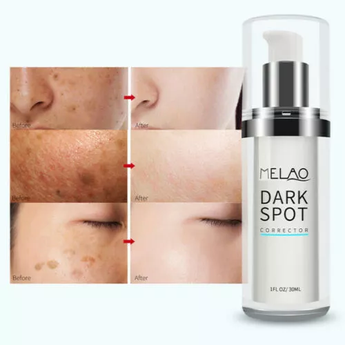 Eliminador de manchas oscuras tratamiento facial y melasma crema de desvanecimiento