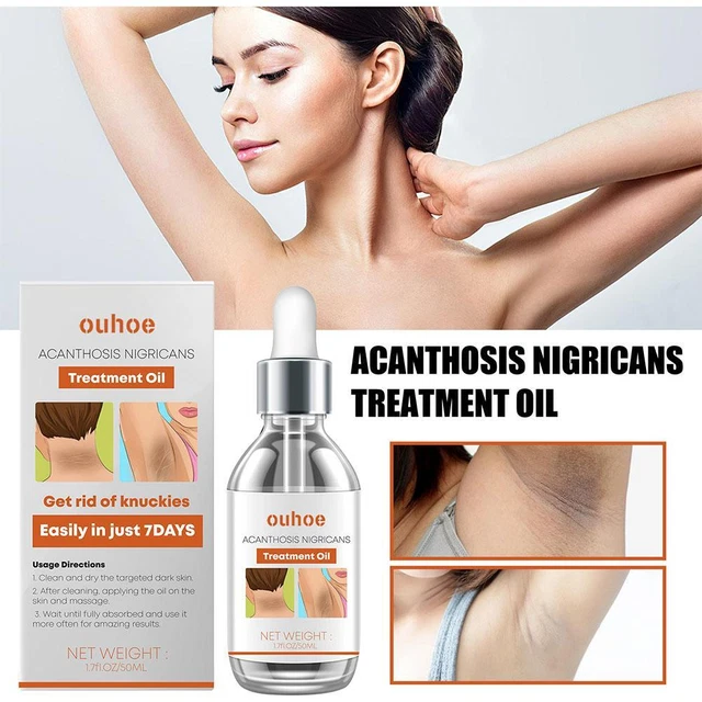 Aceite de tratamiento de acantosis nigricans eliminación de ungüento negro eliminación de manchas oscuras;