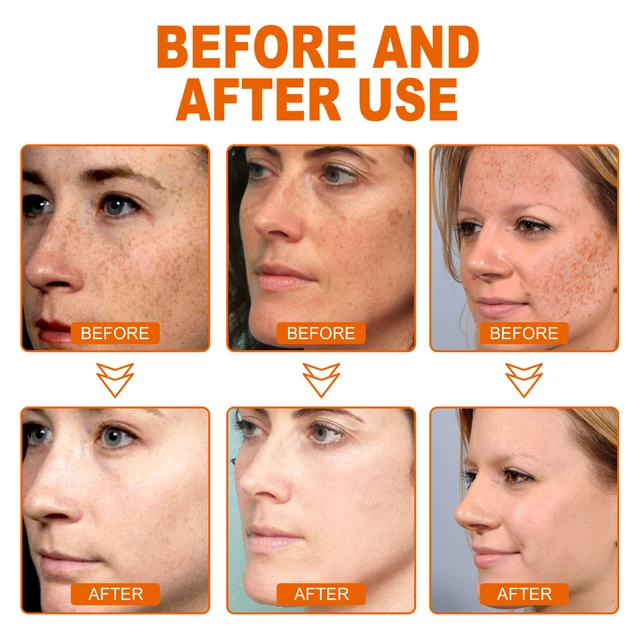3pcs Dark Spot Remover Serum Exfoliating Pigmentation Spot Fading Moisturizi Esp