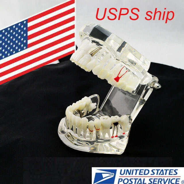 Dentist Study Dental Disease Teeth Model with Restoration & Bridge Tooth CE