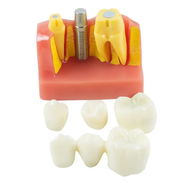 Removable Teeth Model for Implant Analysis - Ideal Dental Study Model - Crown