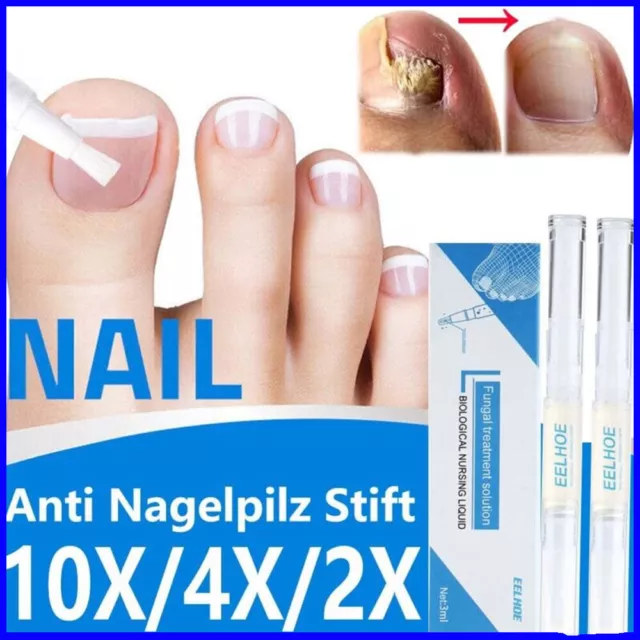 10/8X Anti Nagelpilz Lösung Fußnagelpilz schnell gegen Nagelpilz Behandlung 3ML