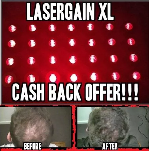 Laser Comb Hair Growth Loss Regrowth Treatment (28x More Power Than Others!)