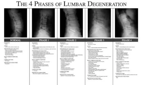 Chiropractic phases of Lumbar degeneration poster