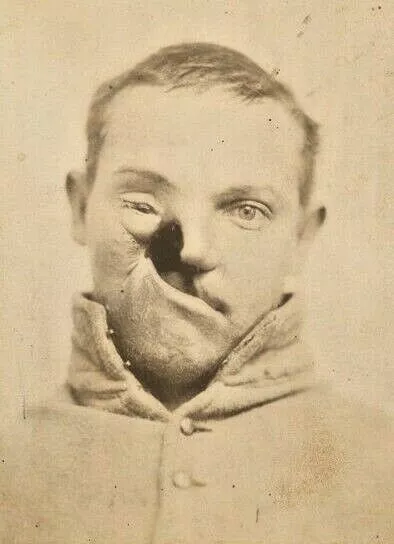 Antique Civil War Medical Photo 353b Oddleys Strange & Bizarre