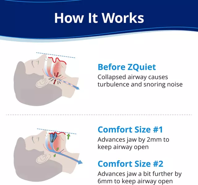 , Anti-Snoring Mouthpiece, Starter Pack with 2 Sizes, Living Hinge & Open Front 3