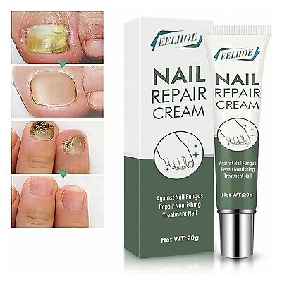 Crema de reparación de uñas eficaz tratamiento de uñas gel para el crecimiento de uñas de los pies crema cutícula
