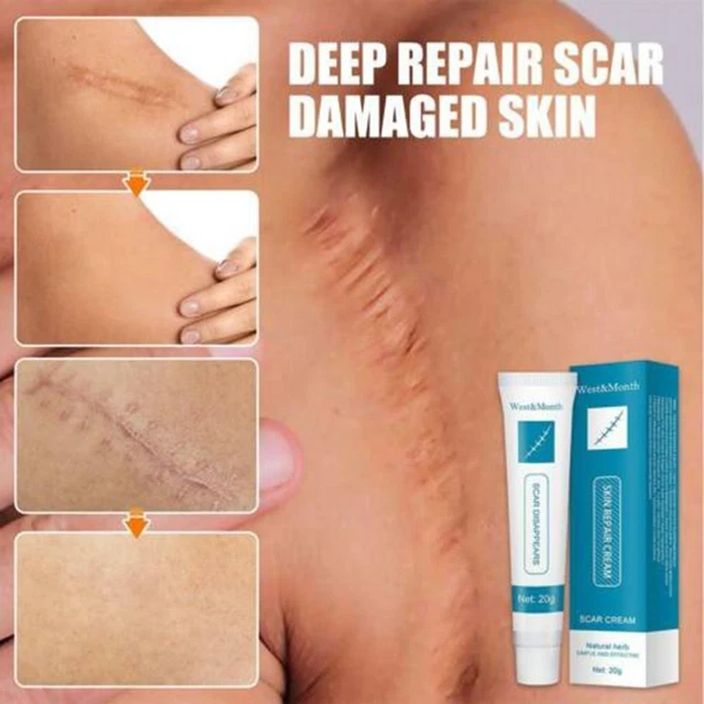 Marks Reduce chirurgia acne cura del corpo cura della pelle per cicatrici migliore crema rimozione cicatrici
