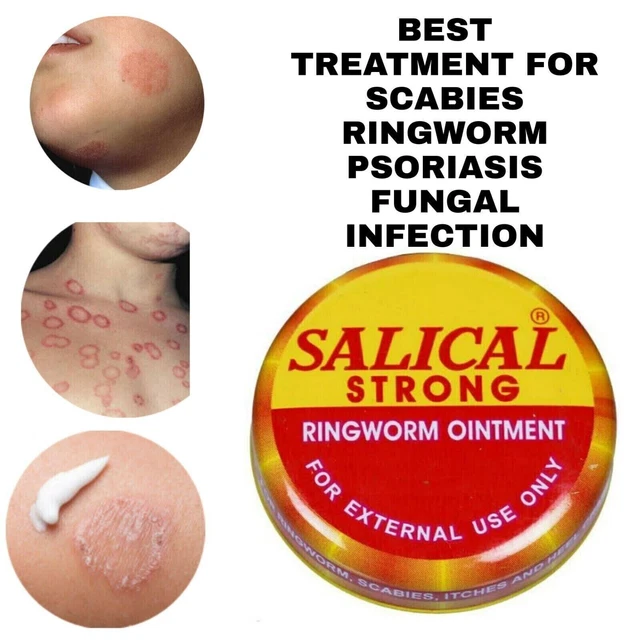 2 X 5gm Salical Strong Tiña Ungüento Cura Picazón Sarna & Talones...