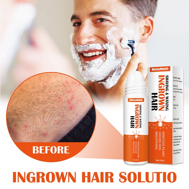 Minoxi Deoroller tratamiento capilar suero cuidado Boost crecimiento del cabello antihilo 🙂