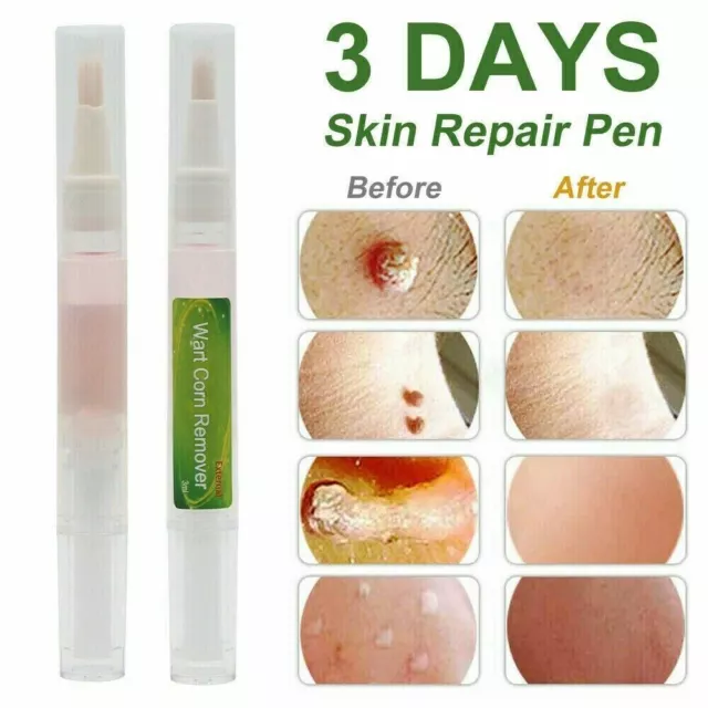 Skin Tag Removal Treatment Cream Face Care Mole Corn Wart Remover Natural Pen