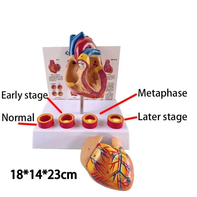 Anatomical Human Life Heart Cardiovascular Thrombotic Vascular Medical Model