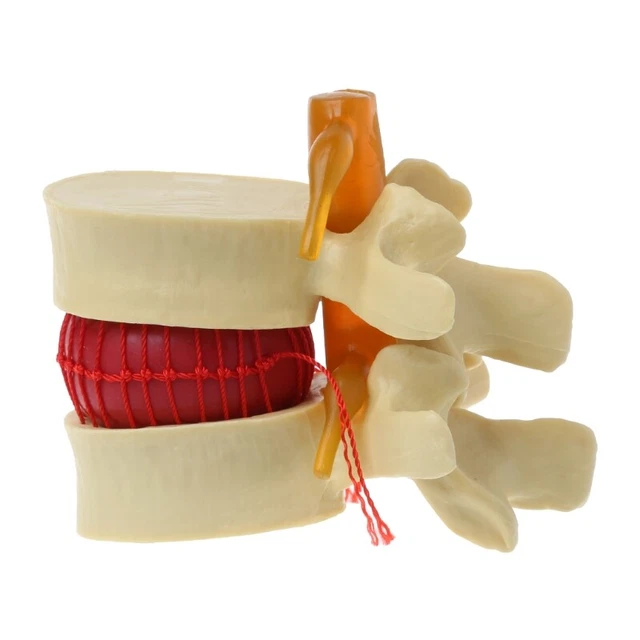 Disc Model Back MEDICAL PROPS MODEL Spine Lumbar Disc Herniation Anatomy Medical ...