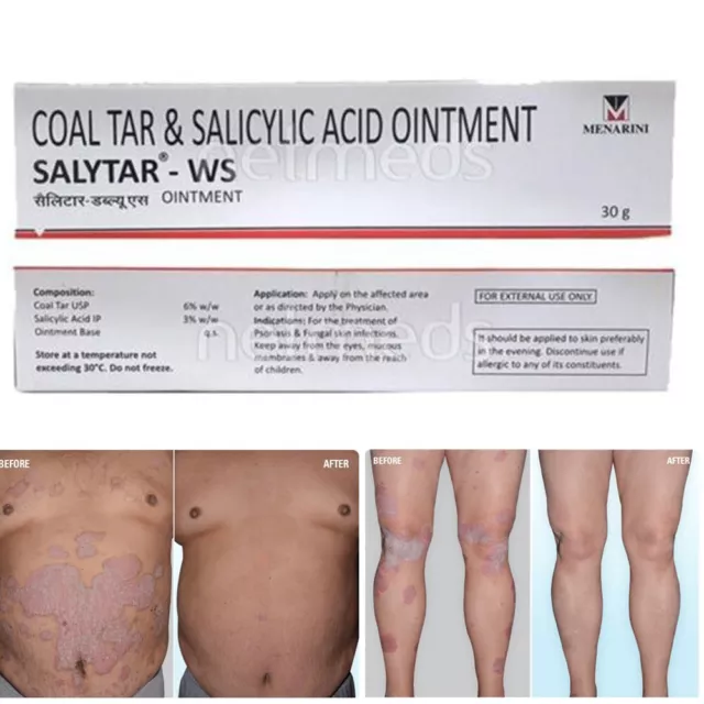 Salytar - 3% Salicylic Acid & 6% Coal Tar Ointment for Dry Skin Moisturizing 30g