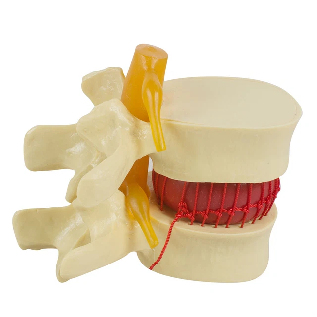 11.5 MEDICAL SPINE Lumbar Disc Herniation Model demonstration Model
