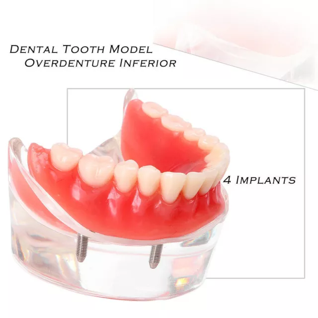 Dental Tooth Model Overdenture Inferior with 4 Implants Demo 6002 Clear Inferior 2