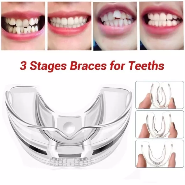 Dental Orthodontic Teeth Corrector Braces Retainer Straighten Tools Tooth^ob