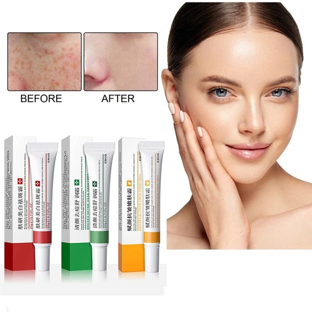 Rimuovi lentiggini schiarente pelle rimozione lentiggini crema idratante acne
