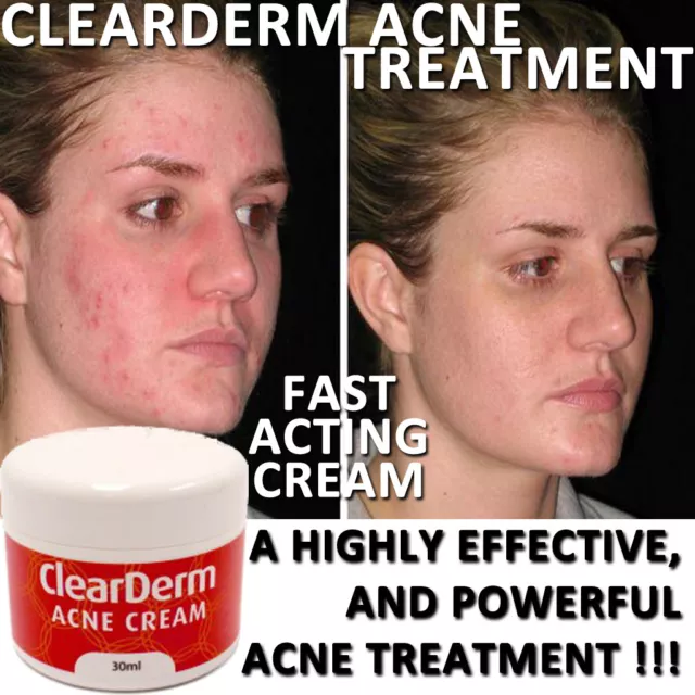 Clearderm Acne Cream Pore Cleanser Stops Spots Bad Skin Works Immediately
