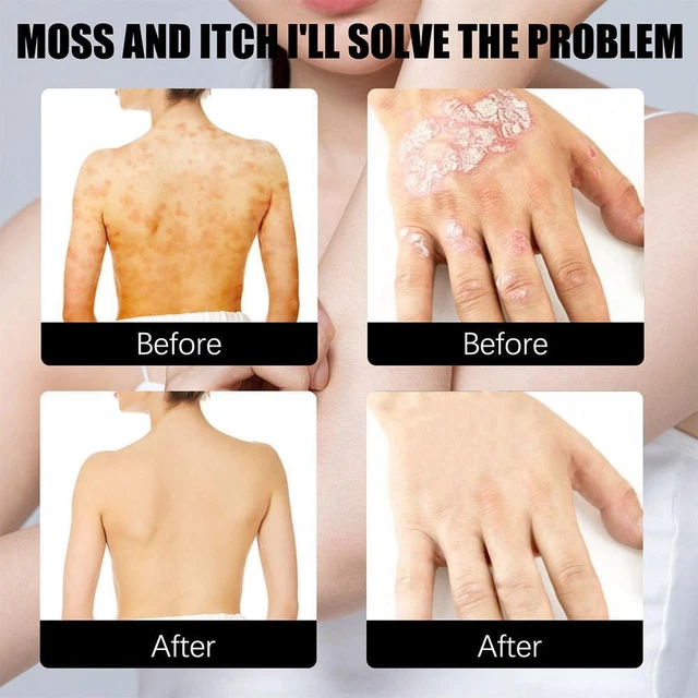 SKIN PSORIASIS SPRAY Herb Essence Dermatitis Eczematoid Spray Eczema