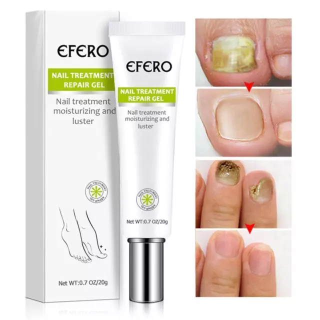 EFERO Nail Anti Fungal Infection Gel Treatment Hand Foot Cream RemoveUKS A0U1