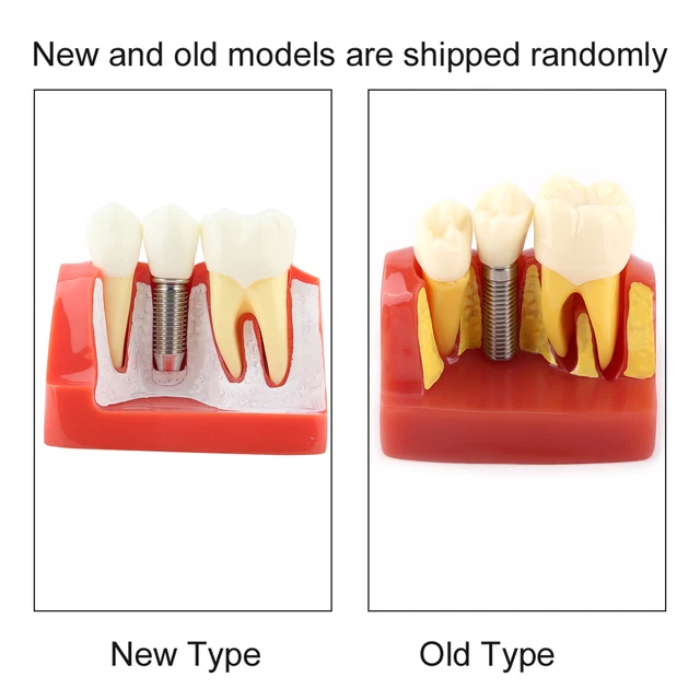 Resin Dental Demonstration Tooth Model Implant Analysis Crown Bridge