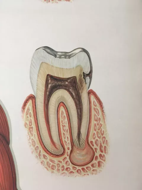 Schulkarte Schulwandkarte Lehrtafel Poster – "kranke Zähne – kranker Körper" 2