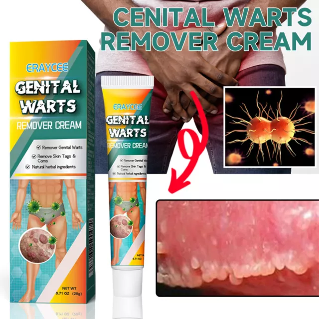 Genital Herpes Wart Remover Ointment Skin Tag Mole Acuminatum Treatment Cream UK