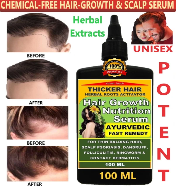 BEST HAIR GROWTH & Scalp Infection Dandruff Itching Herbal Fast Remedy