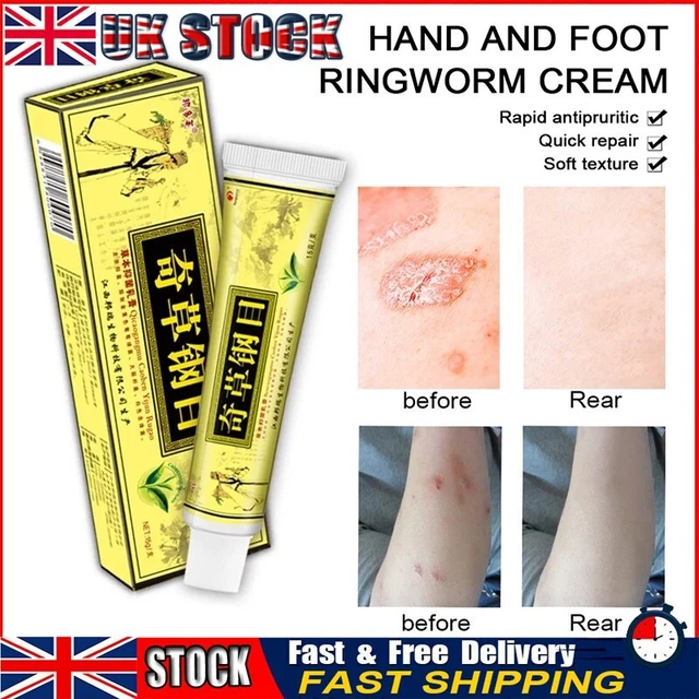 SKIN PSORIASIS CREAM Dermatitis Eczematoid Eczema Ointment Scalp