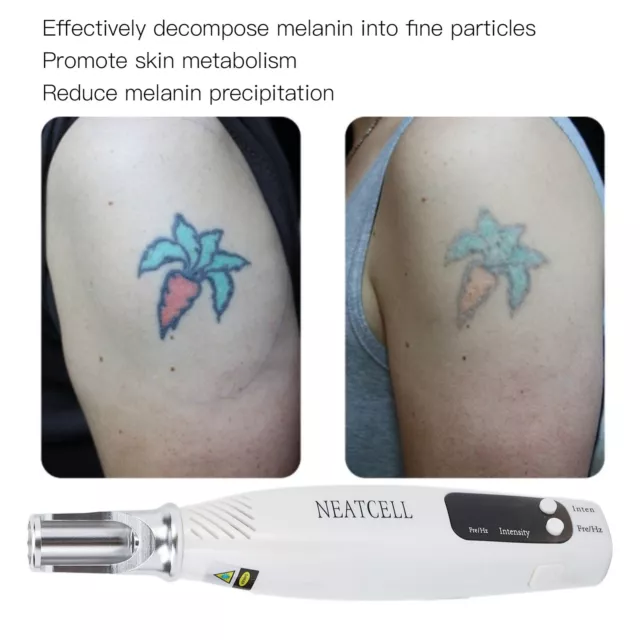 Pluma portátil para la eliminación de tatuajes con láser de picosegundo para el hogar lunar manchas oscuras luz azul