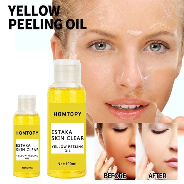 Aceite exfoliante amarillo 30/100 ml aclarar codo rodillas mano para cuerpo manchas oscuras Solutio'