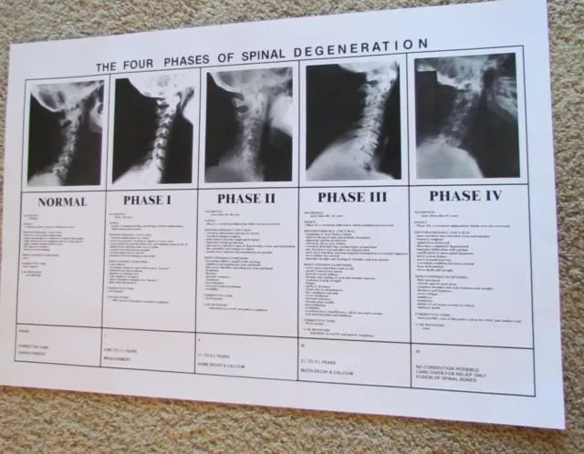 Chiropractic phases of spinal degeneration poster