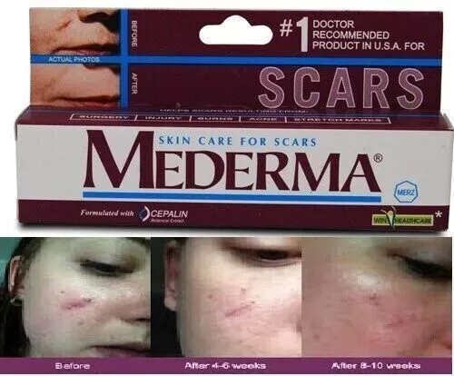 Mederma for Skin STRETCH Care Scars MARK ENTFERNUNG AKNE VERBRENNUNG Behandlung 2