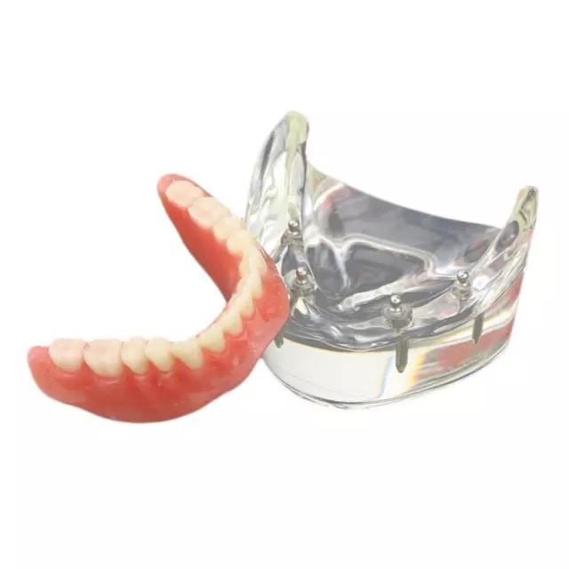 Implant Restroration Model Overdenture Inferior with 4 Implants