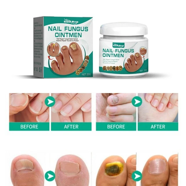 REPAIR PARONYCHIA CARE Ointment Anti fungal Nail Fungus Treatment Serum
