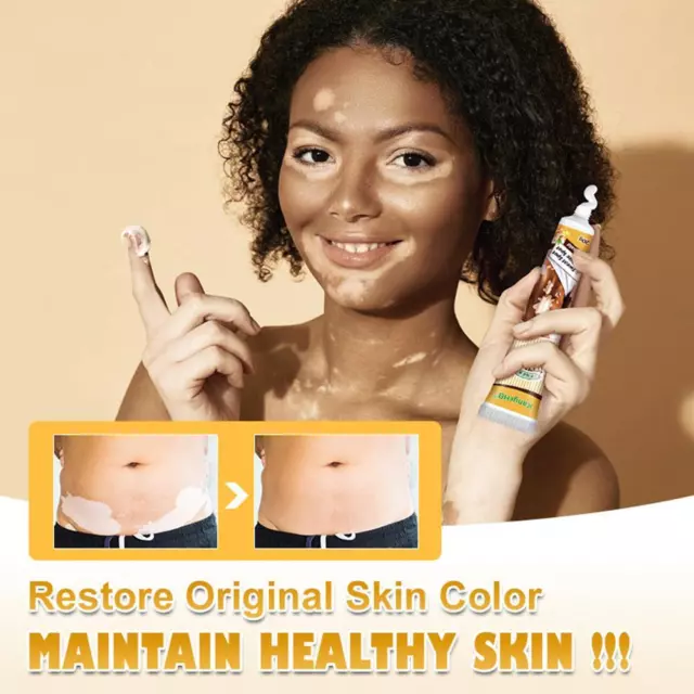 Crema para vitiligo para reducir las manchas blancas en la piel y mejorar la pigmentación de la piel 20 g]
