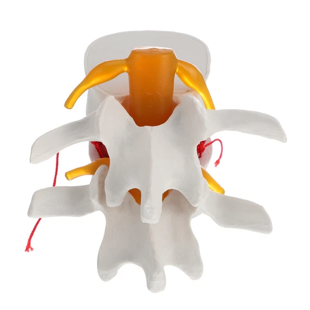 Disc Model Back PRACTICE SPINE MODEL Lumbar Disc Herniation Presentation Human Body £22 ...