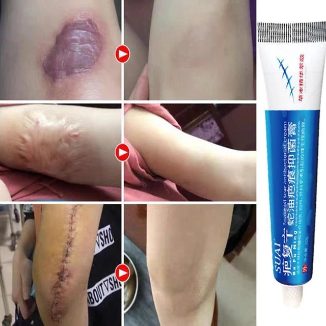 Crema rimozione cicatrici riparazione brufoli graffi cicatrici per tutta la pelle Q5C0