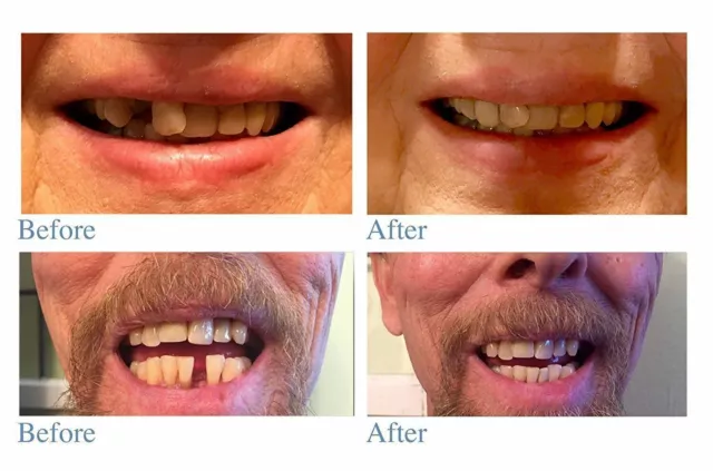 Instant Smile Temporary instant smile temporary Teeth Tooth Kit -Pro-Series 3
