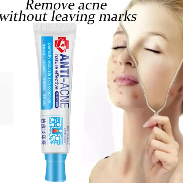 Acne Removal Cream with Scar Dark Spot Treatment for Clear Skin Face Gel