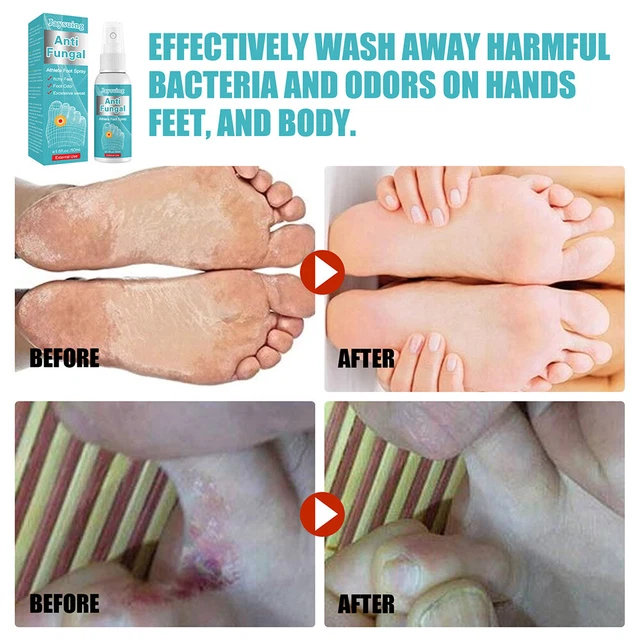 ANTI FUNGAL ATHLETE Feet Spray Toe Paronychia Onychomycosis Anti