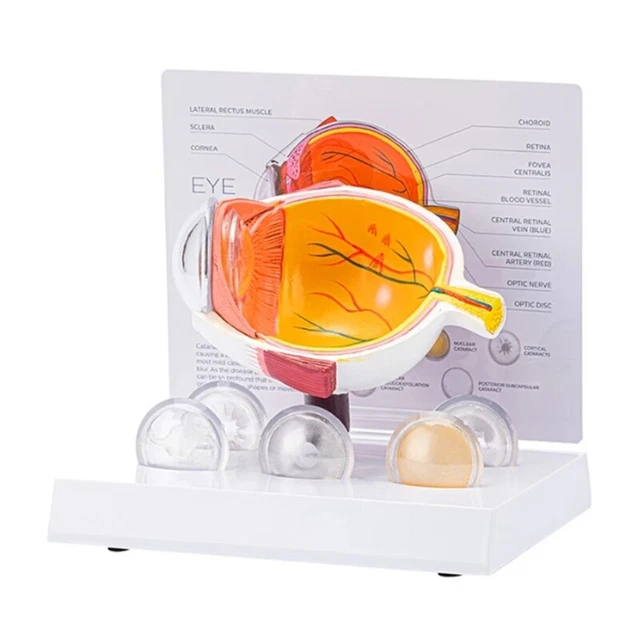 HUMAN ANATOMICAL EYE Model Pathological Eyeball Anatomy Model for ...