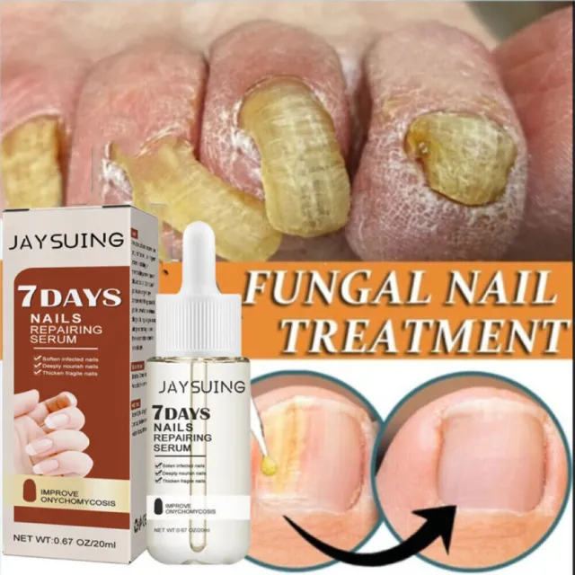 7 Days Nail Repair Serum Fungus Toe Nail Fungus Treatment Onychomycosis Remover