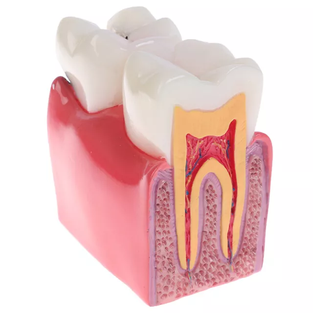 Dental Teeth Model 6 Times Caries Comparation Study Denture Tooth MoD~pd 2