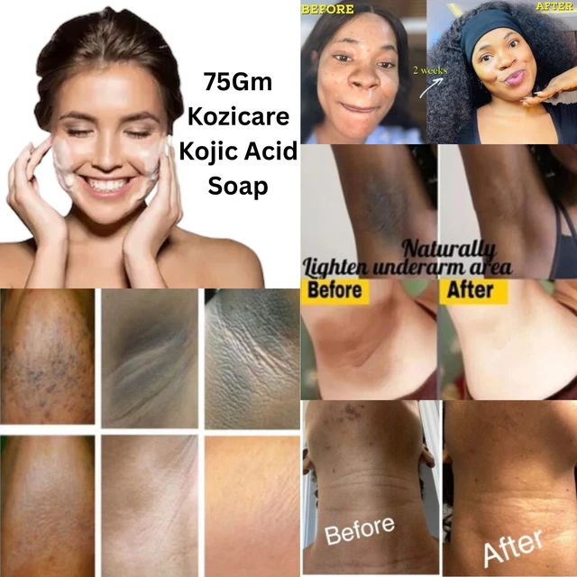 Lot De 6 Savons éclaircissants Kozicare 75g - Enrichis En Acides, Naturel, Pour Tout Type De Peau