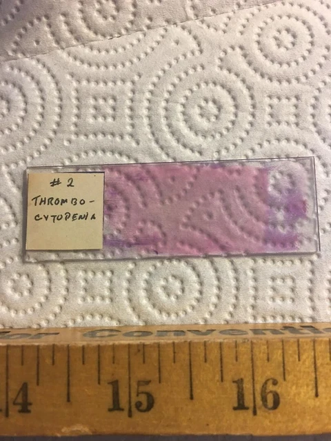 Antique Vintage Microscope Slide  "Thrombocytopenia" #2