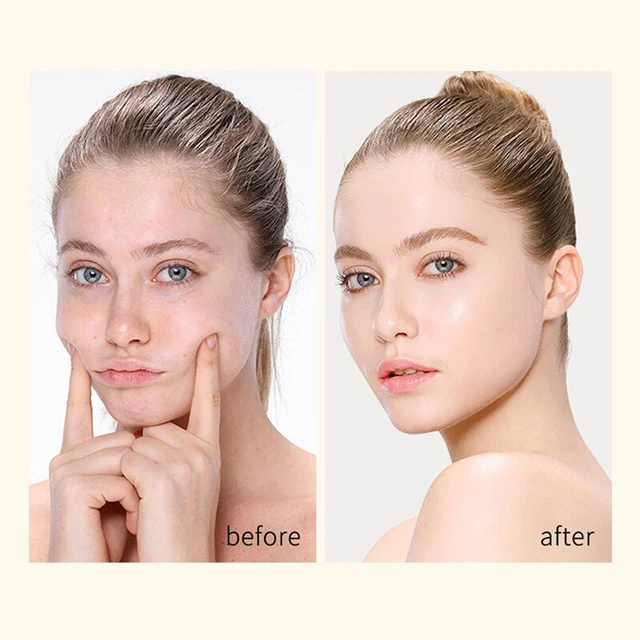 20PCS Face Filler Absorbable Collagen Protein Thread Face Lift Silk Fibroin L-sn