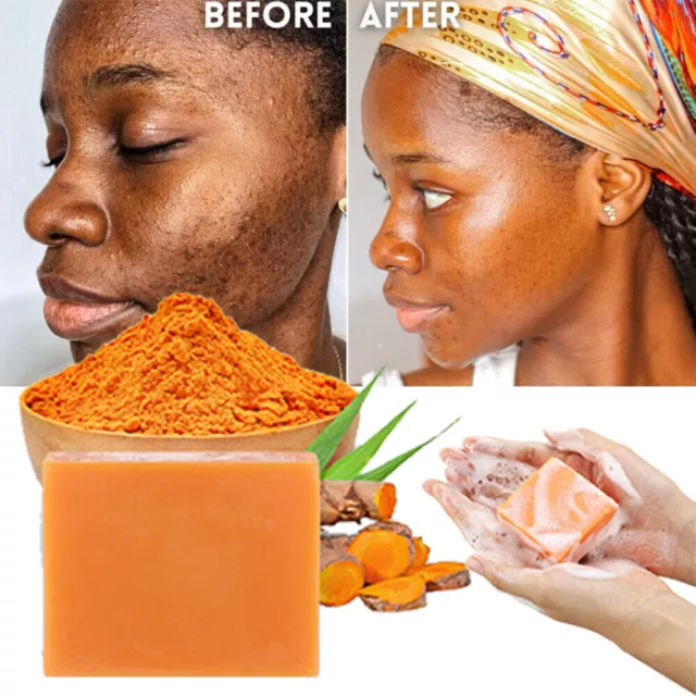 3/2Pack Tumeric Soap Acne For Dark Spots Remove Skin Whitening Body Soaps Bar UK
